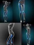 3d Rendering Medical Illustration Of The Femur Bone Stock Photo