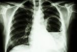 Lung Abscess Stock Photo