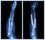 Fracture Both Bone Of Forearm. It Was Operated And Internal Fixed With Plate And Screw (left Image : Before Operation , Right Image : After Operation) Stock Photo