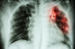 Pulmonary Tuberculosis .  Chest X-ray : Interstitial Infiltratio Stock Photo