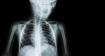 Film X-ray Body Of Child And Blank Area At Right Side ( Medical Background ) Stock Photo