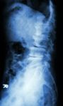 "spondylolisthesis" Stock Photo