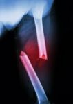 Fracture Femur Stock Photo