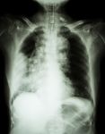 Lung Cancer .  Film Chest X-ray Show Right Lung Mass , Wide Mediastinum , Pneumonia And Right Pleural Effusion Stock Photo