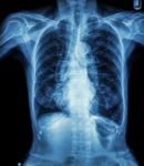 Chest X-ray Of Old Patient ( Calcification At Rib , Trachea , Bronchus ) Stock Photo