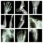 Collection Of Bone Fracture Stock Photo