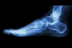 X-ray Normal Human's Foot Lateral Stock Photo