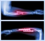 Upper Image : Fracture Ulnar And Radius (forearm Bone) , Lower Image : It Was Operated And Internal Fixed With Plate And Screw Stock Photo