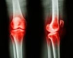 Film X-ray Knee Ap/lateral : Osteoarthritis Knee (inflammation At Knee) Stock Photo