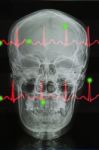 Skull X-rays Image And Lifeline Of Electrocardiogram Stock Photo