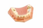 Dental Model (with Different Treatments) Stock Photo