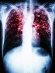 Mycobacterium Tuberculosis Infection (pulmonary Tuberculosis) Stock Photo