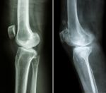 Normal Knee ( Left Image ) And Osteoarthritis Knee ( Right Image ) ( Lateral View ) Stock Photo