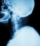 Cervical Spondylosis .  Film X-ray Of Cervical Spine ( Lateral Position ) ( Side View ) Stock Photo