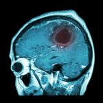 Film Mri Of Brain With Brain Tumor ( Sagittal Plane , Side View , Lateral View ) ( Medical , Health Care , Science Background ) Stock Photo