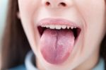 Geographic Tongue Stock Photo