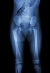 Film X-ray Normal Body Of Child (abdomen,buttock,thigh,knee) Stock Photo