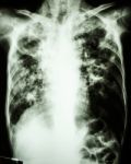 Pulmonary Tuberculosis Stock Photo