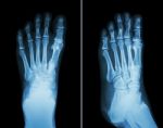 Film X-ray Both Foot ( 2 Position : Front View And Side View ) Stock Photo