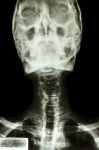 Normal Human's Skull And Cervical Spine Stock Photo