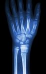 Fracture Distal Radius (forearm's Bone) Stock Photo