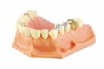 Dental Model (with Different Treatments) Stock Photo