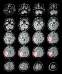 Mri Brain : Brain Tumor At Right Parietal Lobe Stock Photo