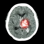 Ct Brain : Show Left Thalamic Hemorrhage (hemorrhagic Stroke) Stock Photo