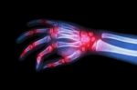 Rheumatoid Arthritis , Gouty Arthritis ( Film X-ray Hand Of Child With Arthritis At Multiple Joint ) Stock Photo