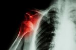 X-ray Anterior Shoulder Dislocation Stock Photo