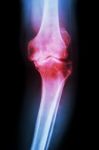 Osteoarthritis Knee Patient Stock Photo