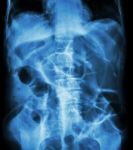 Bowel Obstruction ( X-ray Abdomen Supine Position : Large Bowel Stock Photo