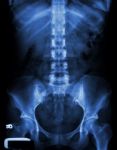 X-ray Lumbo-sacral Spine And Pelvis Of Asian Adult People Stock Photo