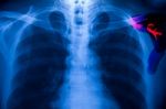 Chest X-ray Stock Photo