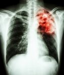 Mycobacterium Tuberculosis Infection (pulmonary Tuberculosis) Stock Photo