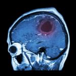 Film Mri Of Brain With Brain Tumor ( Sagittal Plane , Side View , Lateral View ) ( Medical , Health Care , Science Background ) Stock Photo