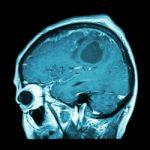 Film Mri Of Brain With Brain Tumor ( Sagittal Plane , Side View , Lateral View ) ( Medical , Health Care , Science Background ) Stock Photo