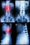 "spondylosis And Spondylolisthesis"  It Was Operated And Internal Fixed At Spine (left Image : Before Operated) (right Image : After Operated) Stock Photo