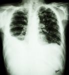 Right Pleural Effusion And Minimal Left Pleural Effusion Due To Stock Photo