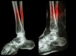 Left Image : Fracture Shaft Of Fibula (calf Bone)  ,  Right Image : It Was Splinted With Plaster Cast Stock Photo