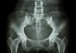 Film X-ray Of Pelvis Stock Photo