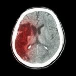 Ct Brain : Show Ischemic Stroke (hypodensity At Right Frontal-pa Stock Photo