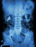 Bilateral Renal Calculi(staghorn) Stock Photo