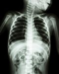 Chest X-ray Of Child Show Neck , Thorax , Shoulder , Arm , Abdomen Stock Photo