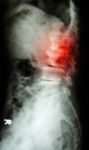 "spondylolisthesis" Stock Photo