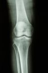 Normal Human's Knee Joint Stock Photo