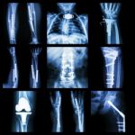 Collection Of Orthopedic Operation Stock Photo