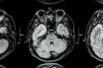 Close Up Of Mri Brain : Lower Part Of Brain ( Eyes , Temporal Lo Stock Photo