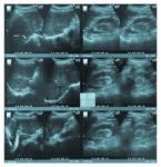 Ultrasonography Image Of Abdomen Stock Photo