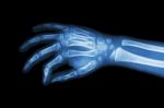 Film X-ray Hand Of Child ( Oblique View ) Stock Photo